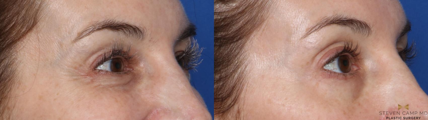 Before & After BOTOX Case 485 Right Oblique View in Fort Worth, Texas