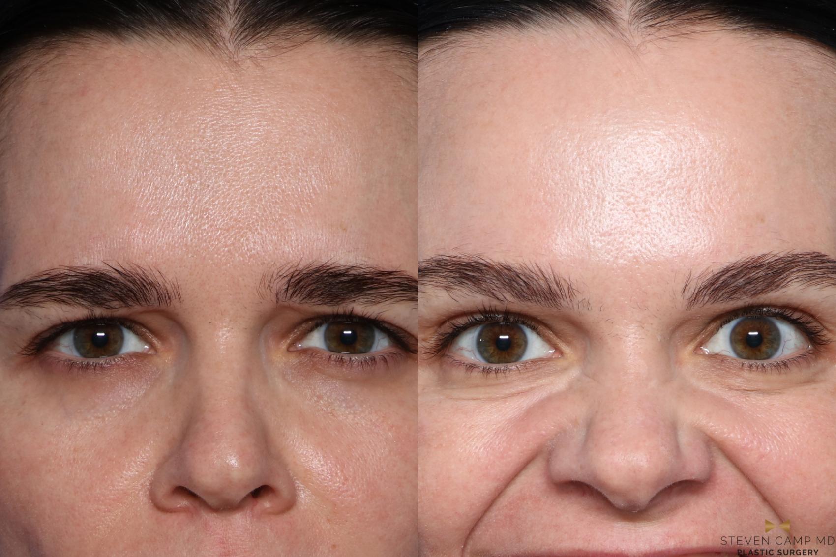 Before & After BOTOX Case 493 Front View in Fort Worth, Texas