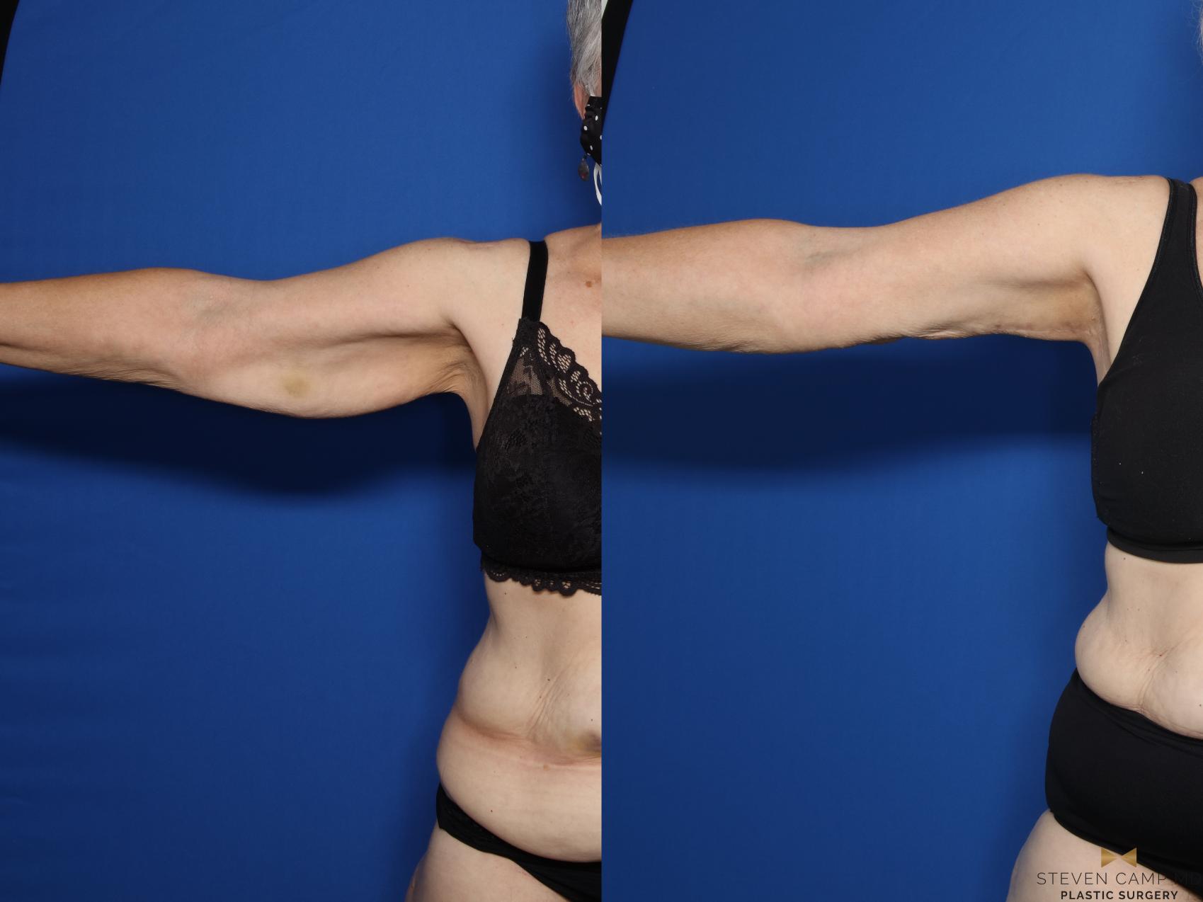 Before & After Brachioplasty Case 574 Front View in Fort Worth & Arlington, Texas