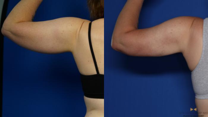 Before & After Brachioplasty Case 575 Back View in Fort Worth & Arlington, Texas