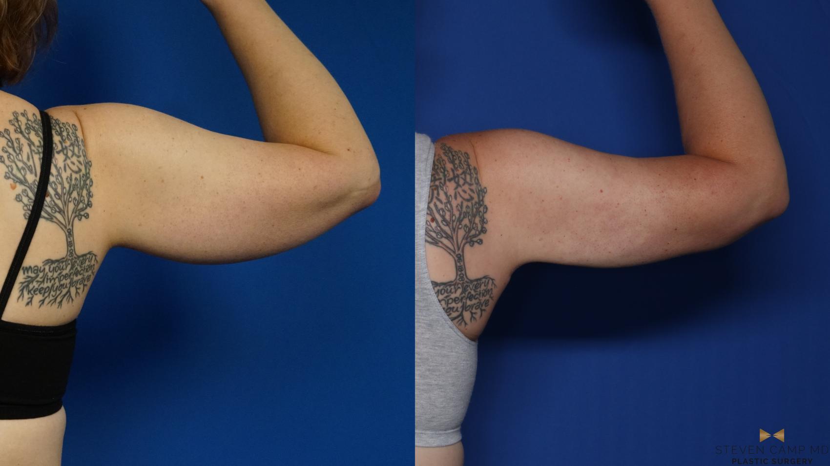 Before & After Brachioplasty Case 575 Right View in Fort Worth & Arlington, Texas