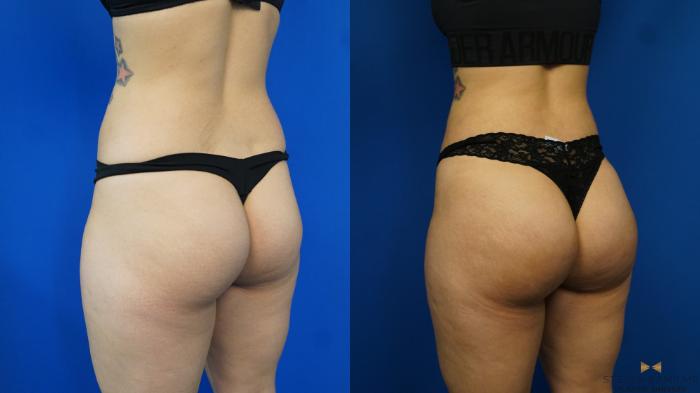 Before & After Brazilian Butt Lift Case 170 View #1 View in Fort Worth, Texas
