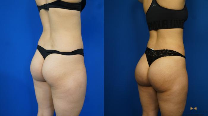 Before & After Brazilian Butt Lift Case 170 View #2 View in Fort Worth & Arlington, Texas