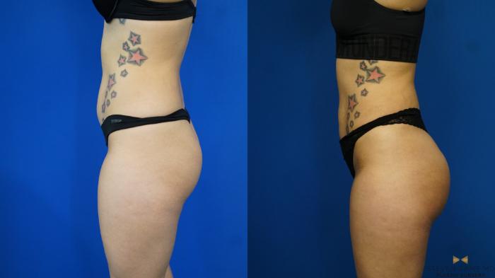 Before & After Brazilian Butt Lift Case 170 View #3 View in Fort Worth & Arlington, Texas