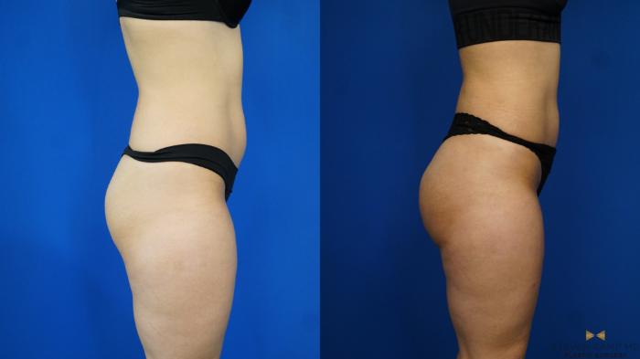 Before & After Brazilian Butt Lift Case 170 View #4 View in Fort Worth & Arlington, Texas