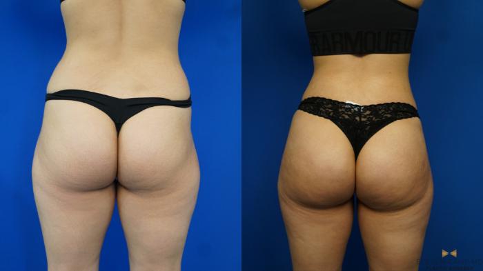 Before & After Brazilian Butt Lift Case 170 View #5 View in Fort Worth & Arlington, Texas