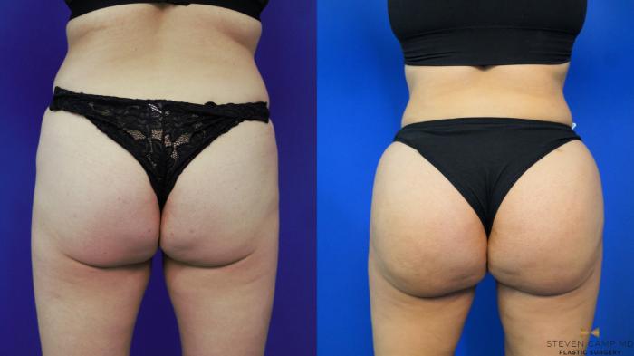 Before & After Brazilian Butt Lift Case 198 View #1 View in Fort Worth & Arlington, Texas