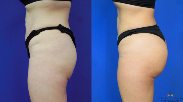 Before & After Brazilian Butt Lift Case 198 View #2 View in Fort Worth & Arlington, Texas