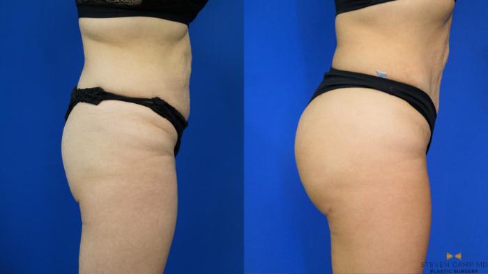 Before & After Brazilian Butt Lift Case 198 View #3 View in Fort Worth & Arlington, Texas