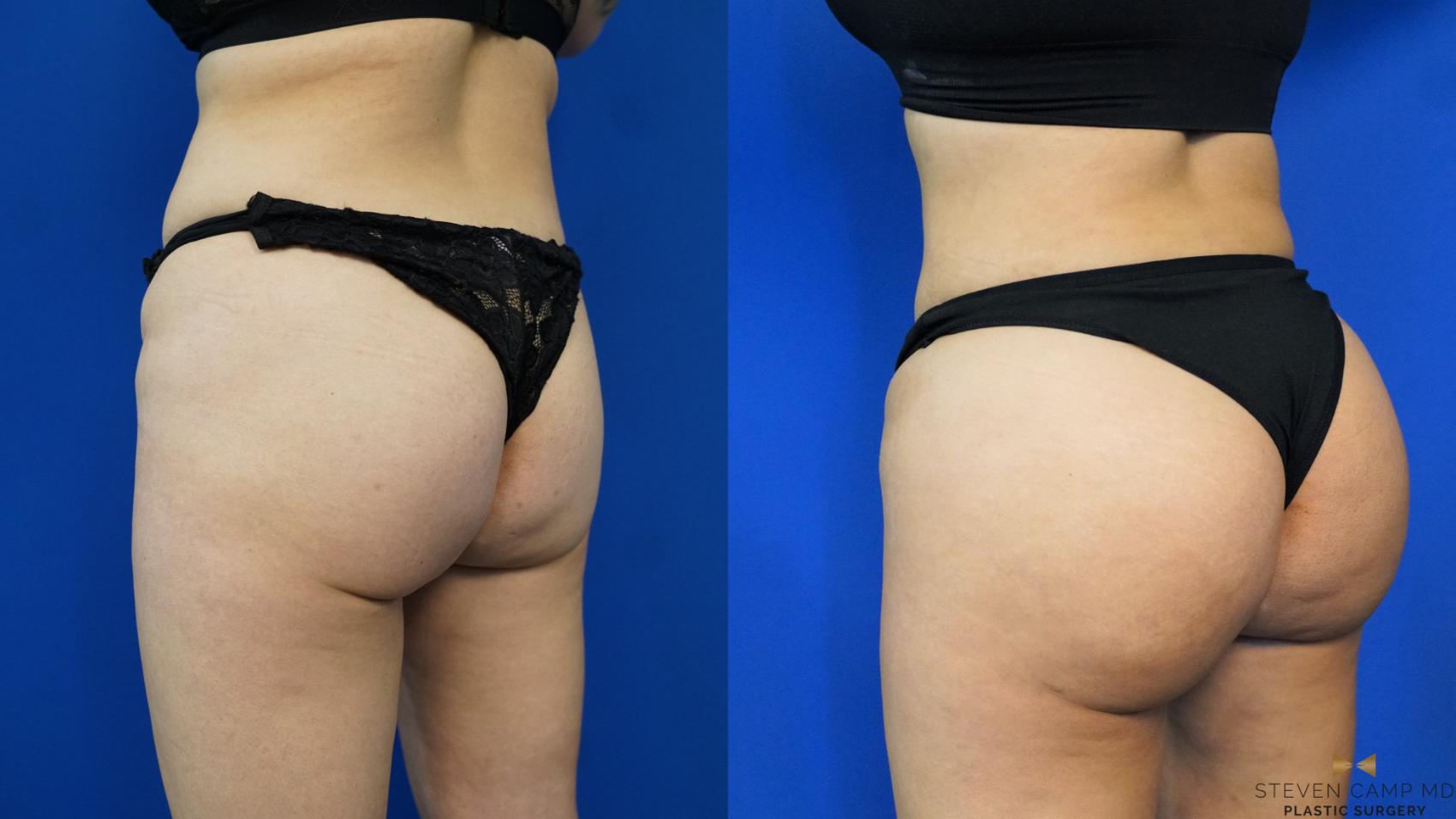 Before & After Brazilian Butt Lift Case 198 View #4 View in Fort Worth, Texas