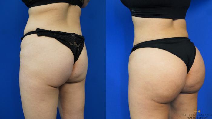 Before & After Brazilian Butt Lift Case 198 View #4 View in Fort Worth & Arlington, Texas