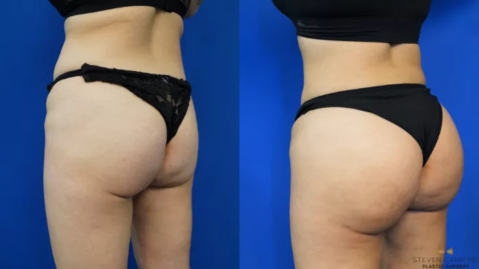 Brazilian Butt Lift & Lipo Post-Op Kit – NY Cosmetic Surgery Supplies