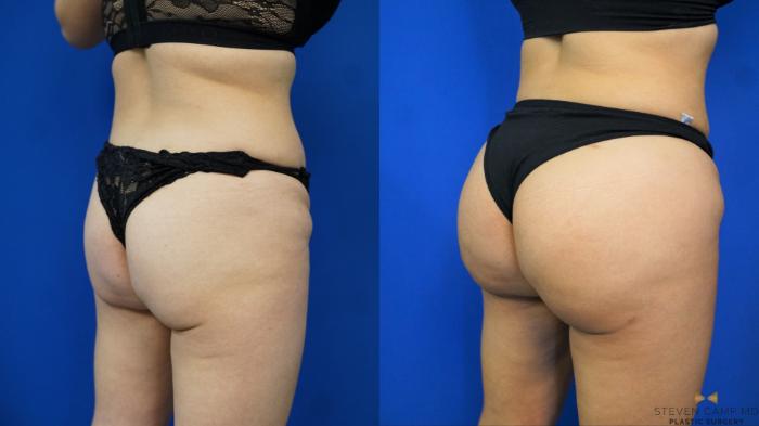 Before & After Brazilian Butt Lift Case 198 View #5 View in Fort Worth & Arlington, Texas