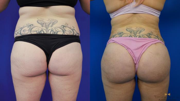 Before & After Brazilian Butt Lift Case 199 View #1 View in Fort Worth, Texas