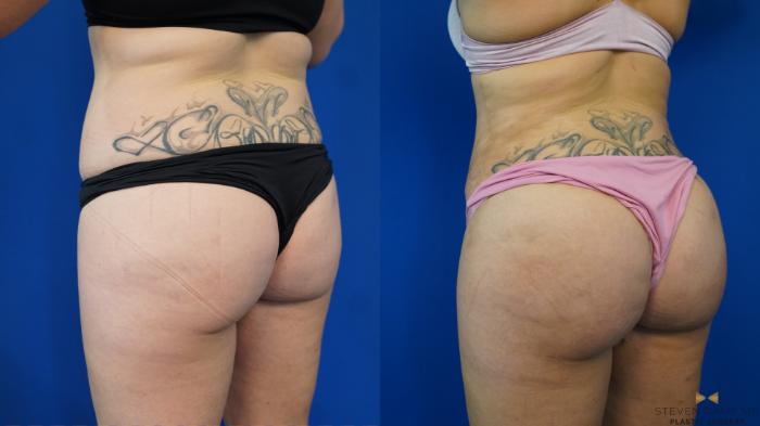 Before & After Brazilian Butt Lift Case 199 View #2 View in Fort Worth & Arlington, Texas