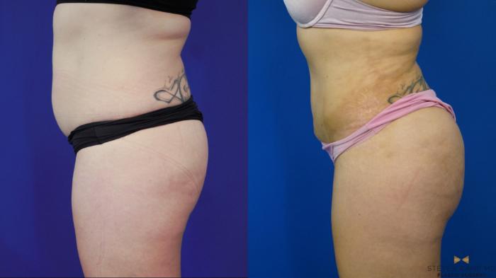 Before & After Brazilian Butt Lift Case 199 View #3 View in Fort Worth & Arlington, Texas
