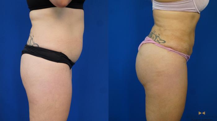 Before & After Brazilian Butt Lift Case 199 View #4 View in Fort Worth & Arlington, Texas