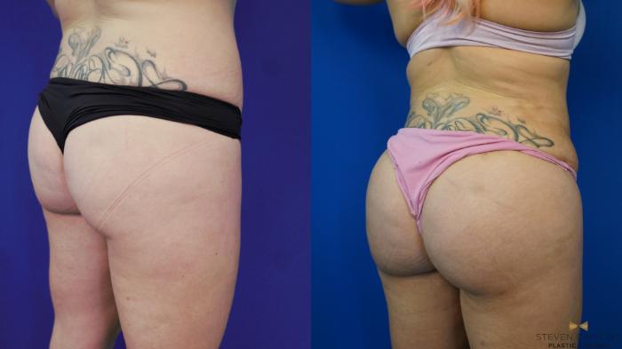 Before & After Brazilian Butt Lift Case 199 View #5 View in Fort Worth & Arlington, Texas