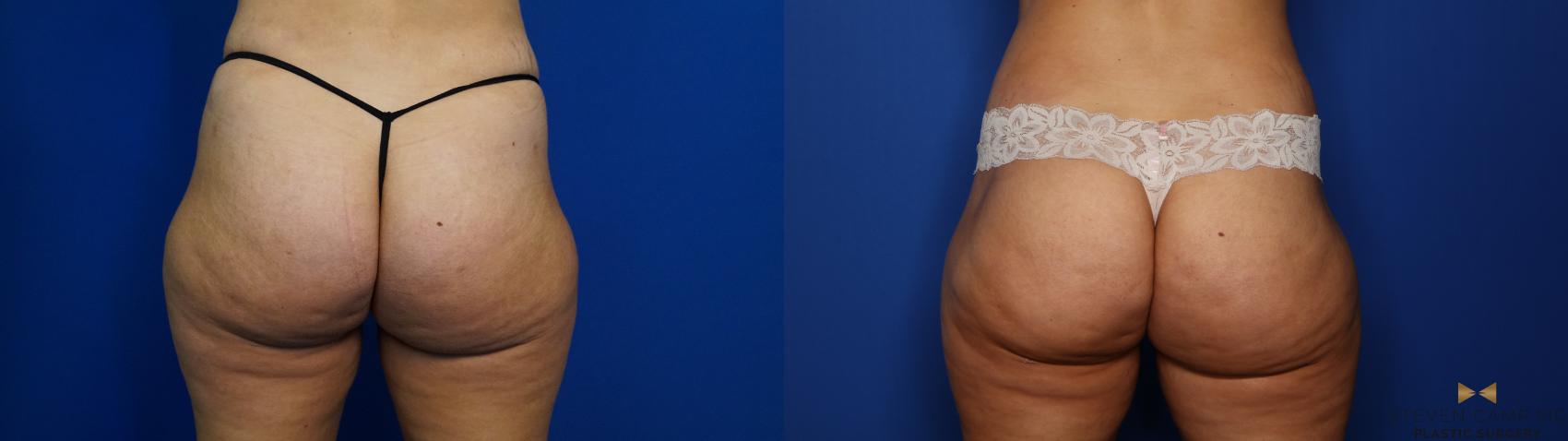 Before & After Brazilian Butt Lift Case 405 Back View in Fort Worth & Arlington, Texas