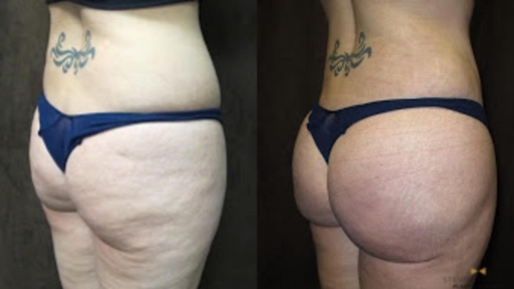 Before & After Brazilian Butt Lift Case 84 View #1 View in Fort Worth & Arlington, Texas