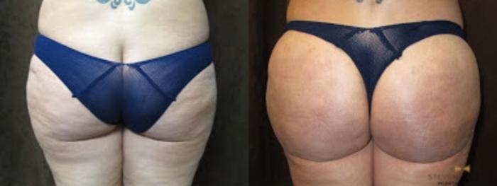 Before & After Brazilian Butt Lift Case 84 View #2 View in Fort Worth & Arlington, Texas