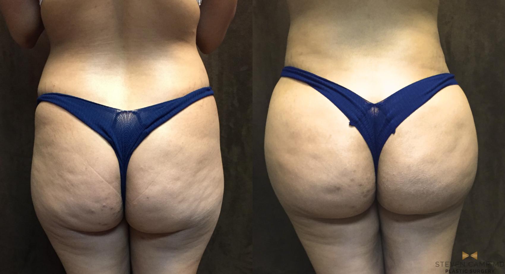 Before & After Brazilian Butt Lift Case 94 View #1 View in Fort Worth, Texas