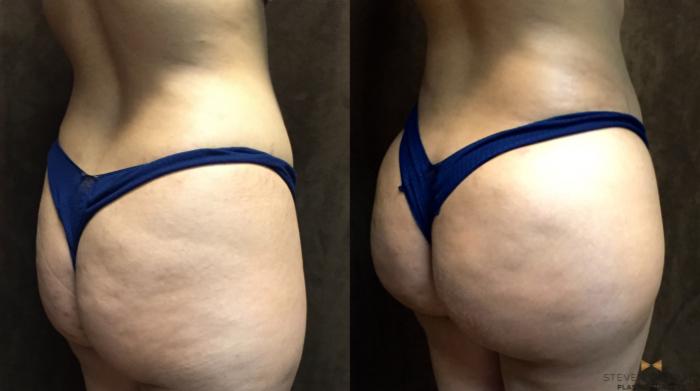 Before & After Brazilian Butt Lift Case 94 View #2 View in Fort Worth, Texas