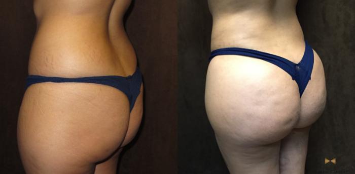 Before & After Brazilian Butt Lift Case 94 View #4 View in Fort Worth & Arlington, Texas