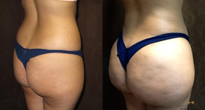 Before & After Brazilian Butt Lift Case 94 View #5 View in Fort Worth, Texas