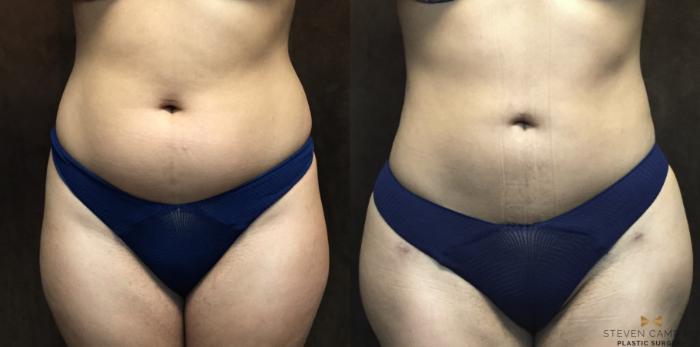 Before & After Brazilian Butt Lift Case 94 View #6 View in Fort Worth, Texas