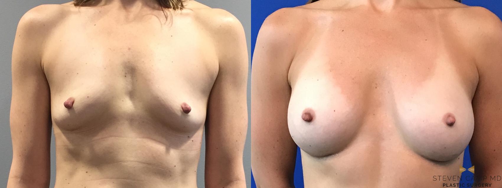 Before & After Breast Augmentation Case 101 View #1 View in Fort Worth, Texas