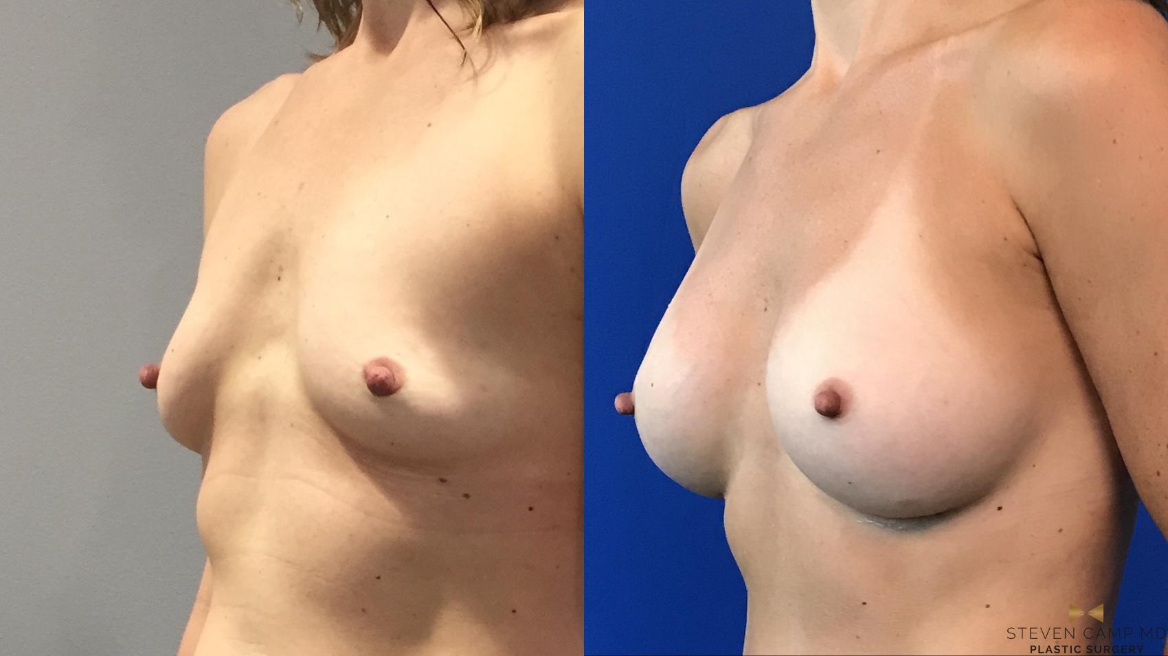 Before & After Breast Augmentation Case 101 View #2 View in Fort Worth, Texas