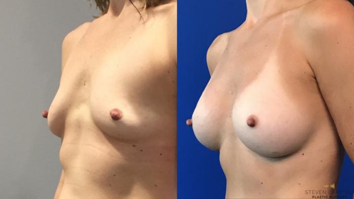 Before & After Breast Augmentation Case 101 View #2 View in Fort Worth & Arlington, Texas