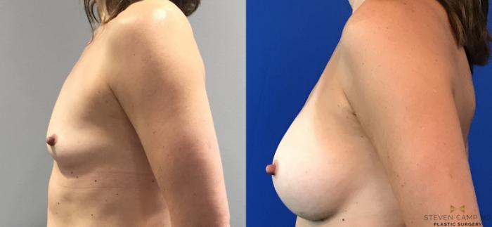 Before & After Breast Augmentation Case 101 View #3 View in Fort Worth & Arlington, Texas