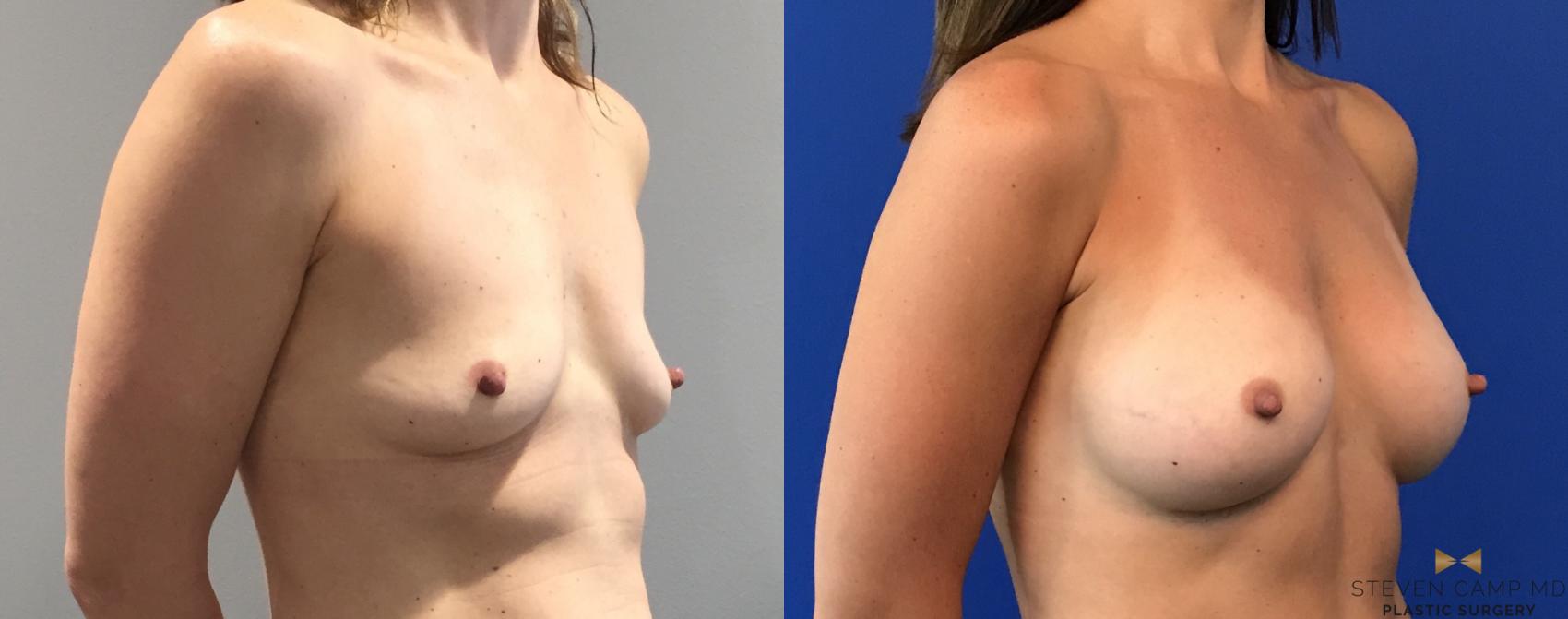 Before & After Breast Augmentation Case 101 View #4 View in Fort Worth, Texas