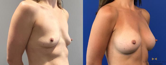 Before & After Breast Augmentation Case 101 View #4 View in Fort Worth & Arlington, Texas