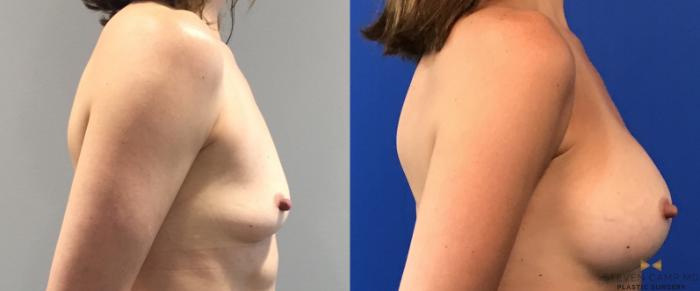 Before & After Breast Augmentation Case 101 View #5 View in Fort Worth & Arlington, Texas