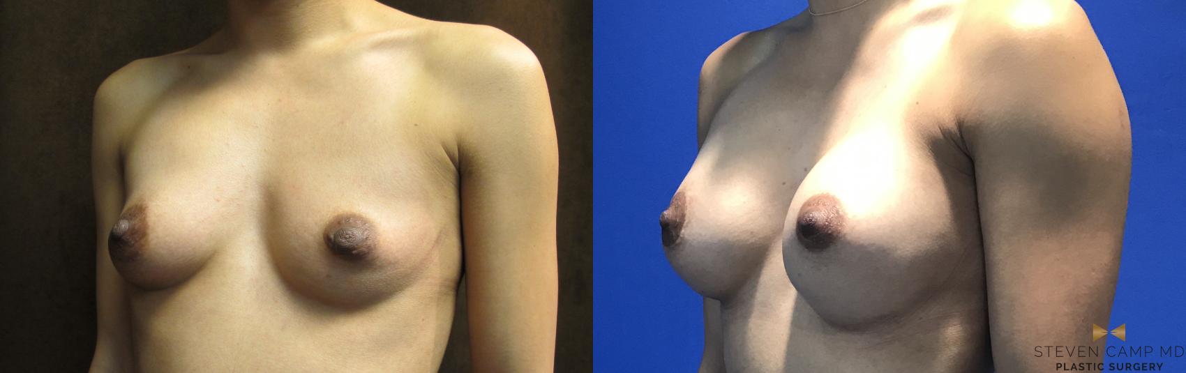 Before & After Case2968 by Steven Camp MD Plastic Surgery & Aesthetics, in Fort Worth