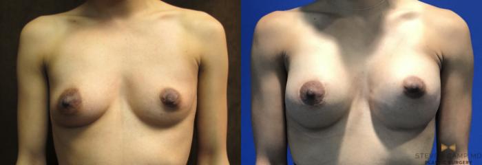 Before & After Breast Augmentation Case 103 View #2 View in Fort Worth, Texas