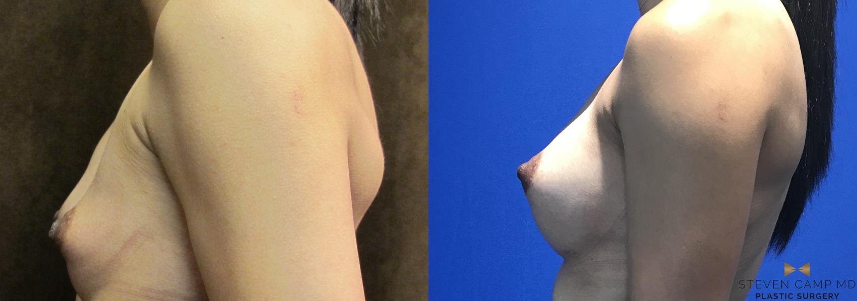 Before & After Breast Augmentation Case 103 View #3 View in Fort Worth & Arlington, Texas