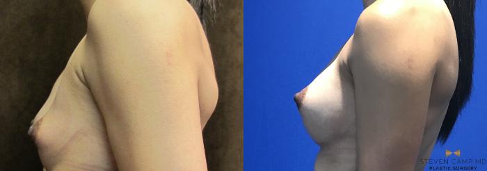 Before & After Breast Augmentation Case 103 View #3 View in Fort Worth, Texas