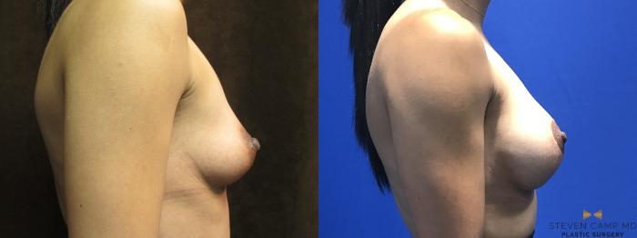 Before & After Breast Augmentation Case 103 View #5 View in Fort Worth, Texas