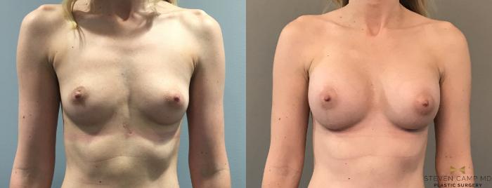 Before & After Breast Augmentation Case 105 View #1 View in Fort Worth, Texas