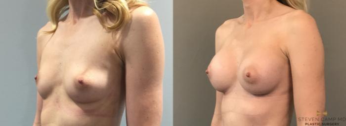 Before & After Breast Augmentation Case 105 View #2 View in Fort Worth, Texas