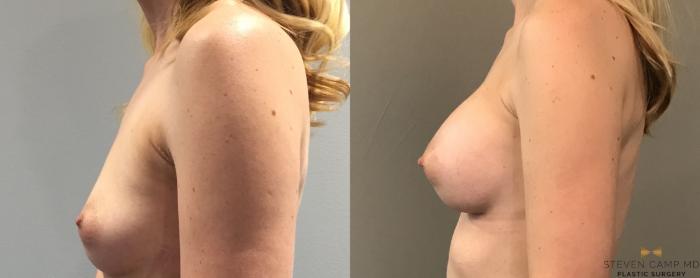 Before & After Breast Augmentation Case 105 View #3 View in Fort Worth, Texas