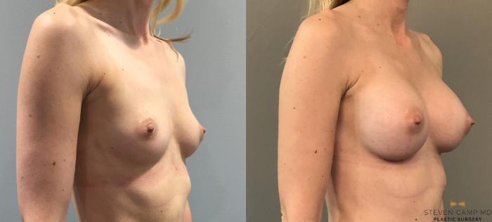 Before & After Breast Augmentation Case 105 View #4 View in Fort Worth, Texas