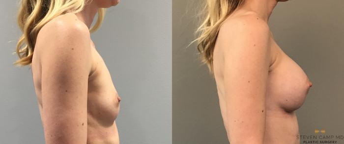 Before & After Breast Augmentation Case 105 View #5 View in Fort Worth, Texas