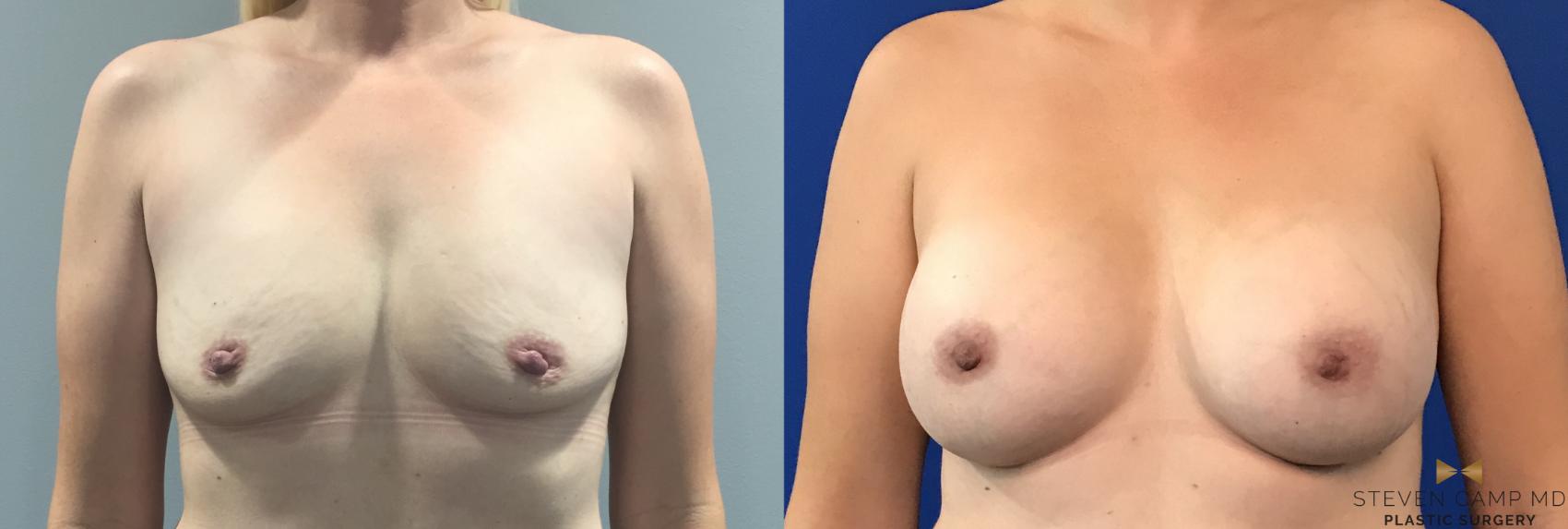 Before & After Breast Augmentation Case 109 View #1 View in Fort Worth, Texas