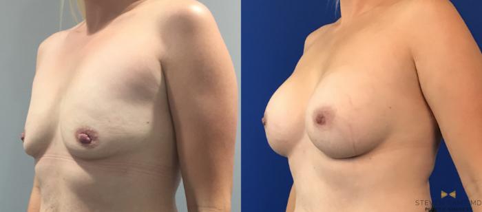 Before & After Breast Augmentation Case 109 View #2 View in Fort Worth, Texas