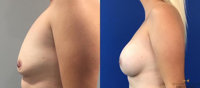Before & After Breast Augmentation Case 109 View #3 View in Fort Worth, Texas